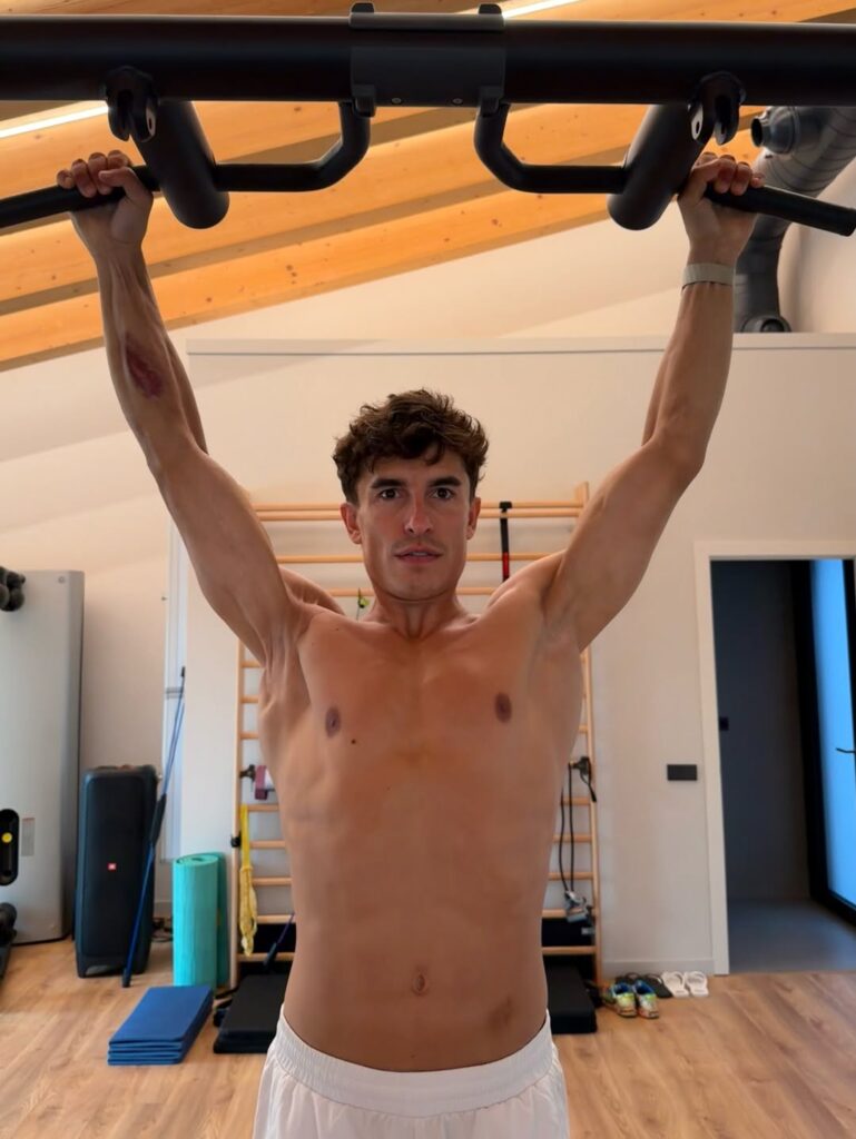 La foto di Marc Marquez dove si vede la condizione della spalla destra (© Profilo Instagram Marc Marquez)
